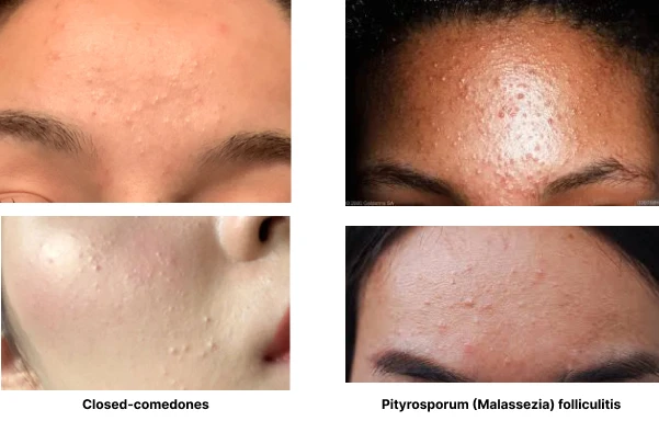 Closed comedones vs fungal acne/Pityrosporum (Malassezia) folliculitis